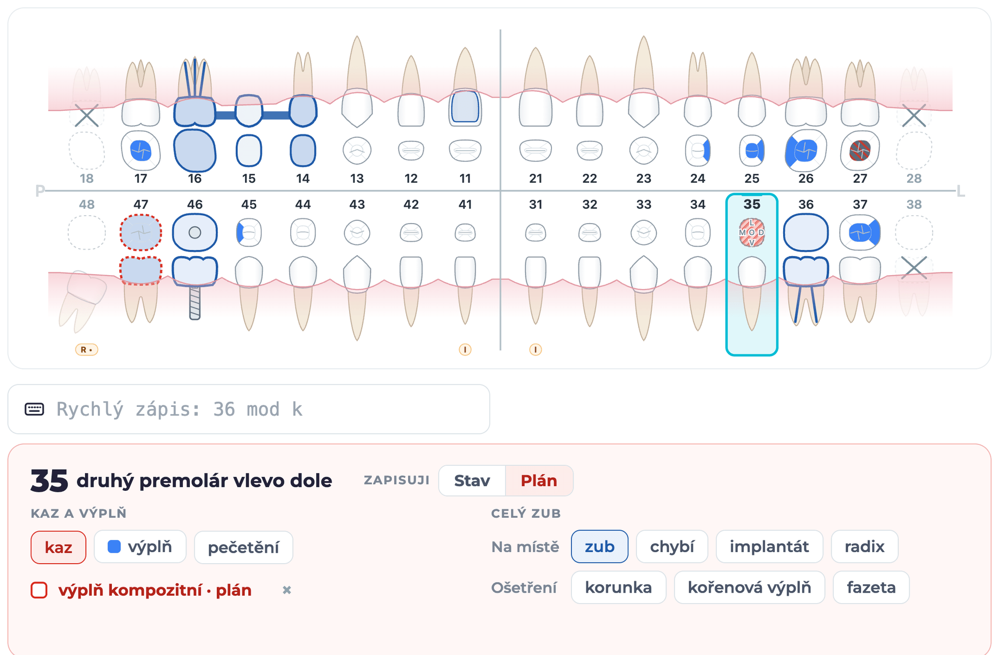 Kříž s vybraným zubem 35 a panel zubu v režimu Plán s výplní k odškrtnutí