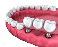 depositphotos_74112949-stock-photo-dental-implants-crowns-and-pins-300x245.png